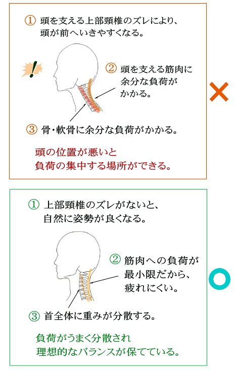 上部頸椎が首の歪みのもと