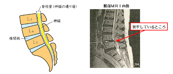 脊柱管狭窄症の説明図