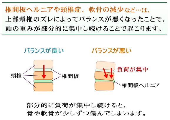 椎間板ヘルニアはバランスが大事