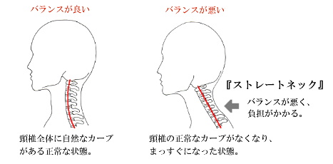 ストレートネック説明イラスト