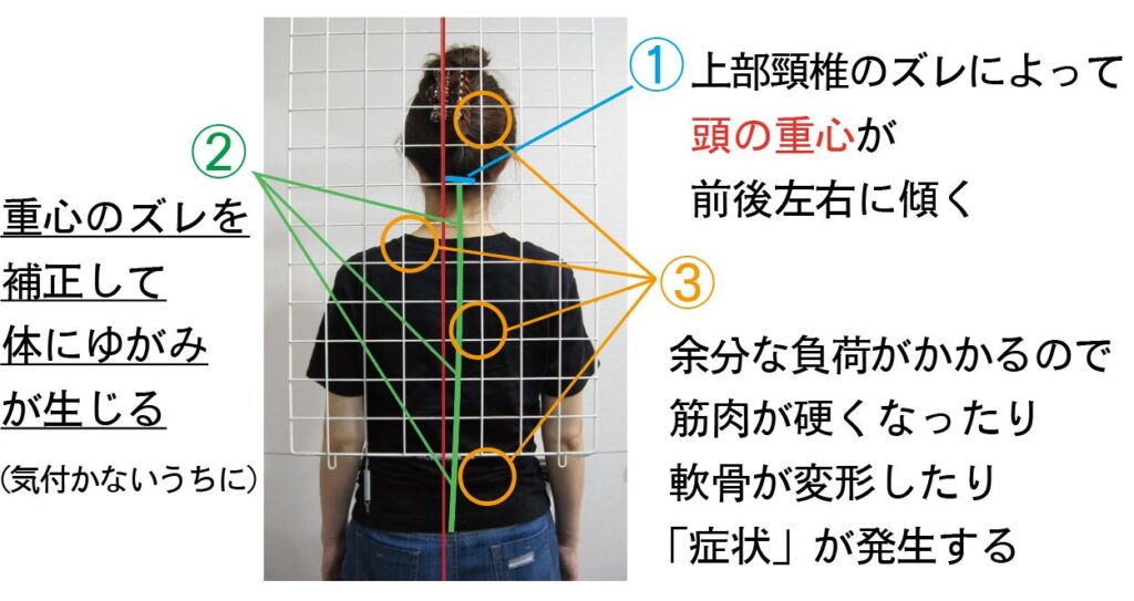 上部頸椎が体のゆがみの原因である理由